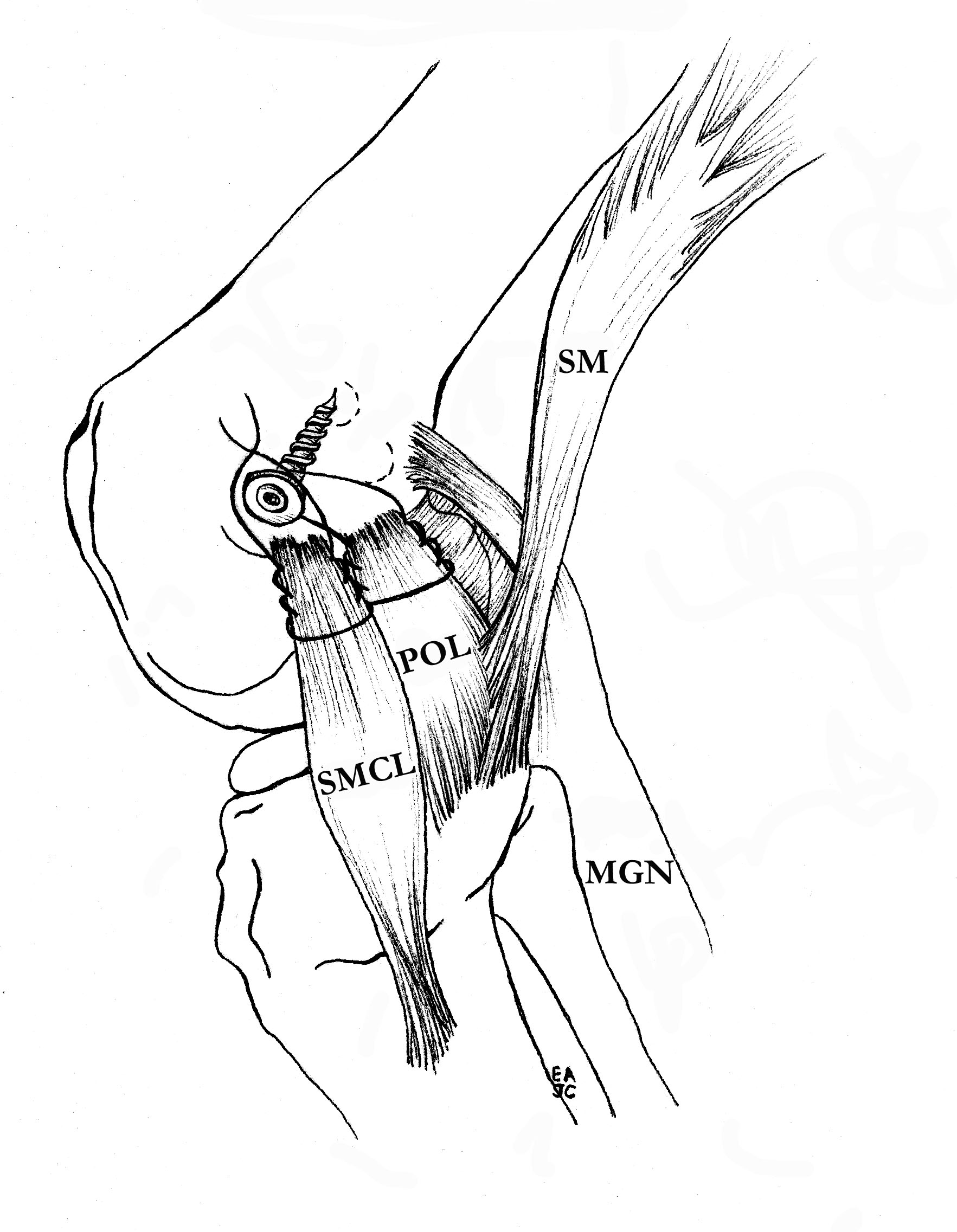 MCL Femoral fixation 2